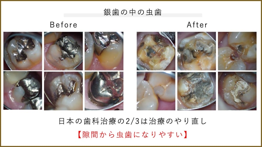 詰め物・被せ物の経年劣化と隙間の発生