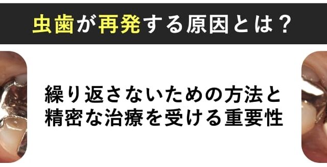虫歯が再発する原因とは？二次カリエスの仕組みと繰り返さないための予防・治療法
