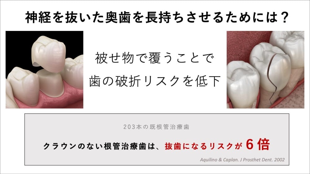神経を抜いた奥歯を長持ちさせるためには？