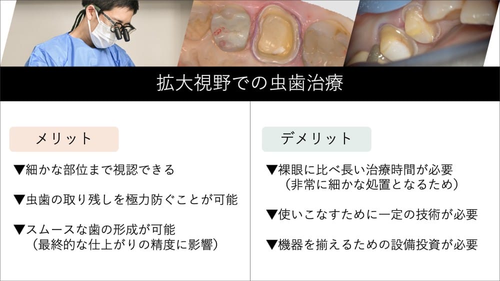 精密な虫歯除去と適合精度｜拡大鏡・マイクロスコープの役割