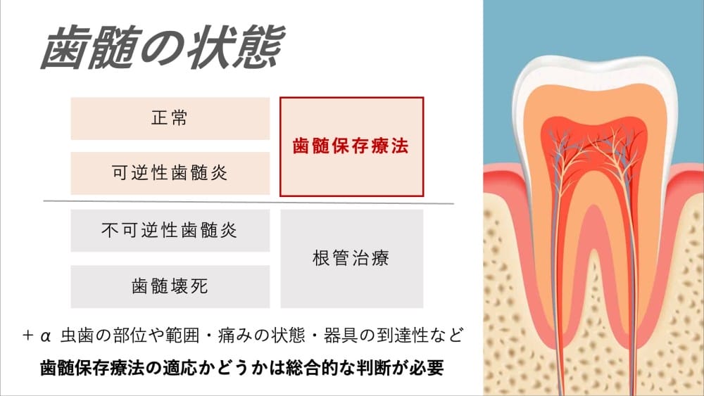 再発虫歯が神経に達したら｜根管治療の判断基準